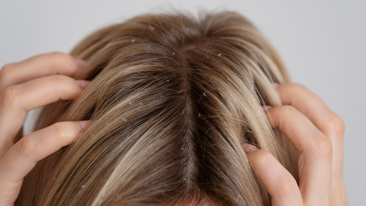 Types Of Dandruff And How To Treat Them