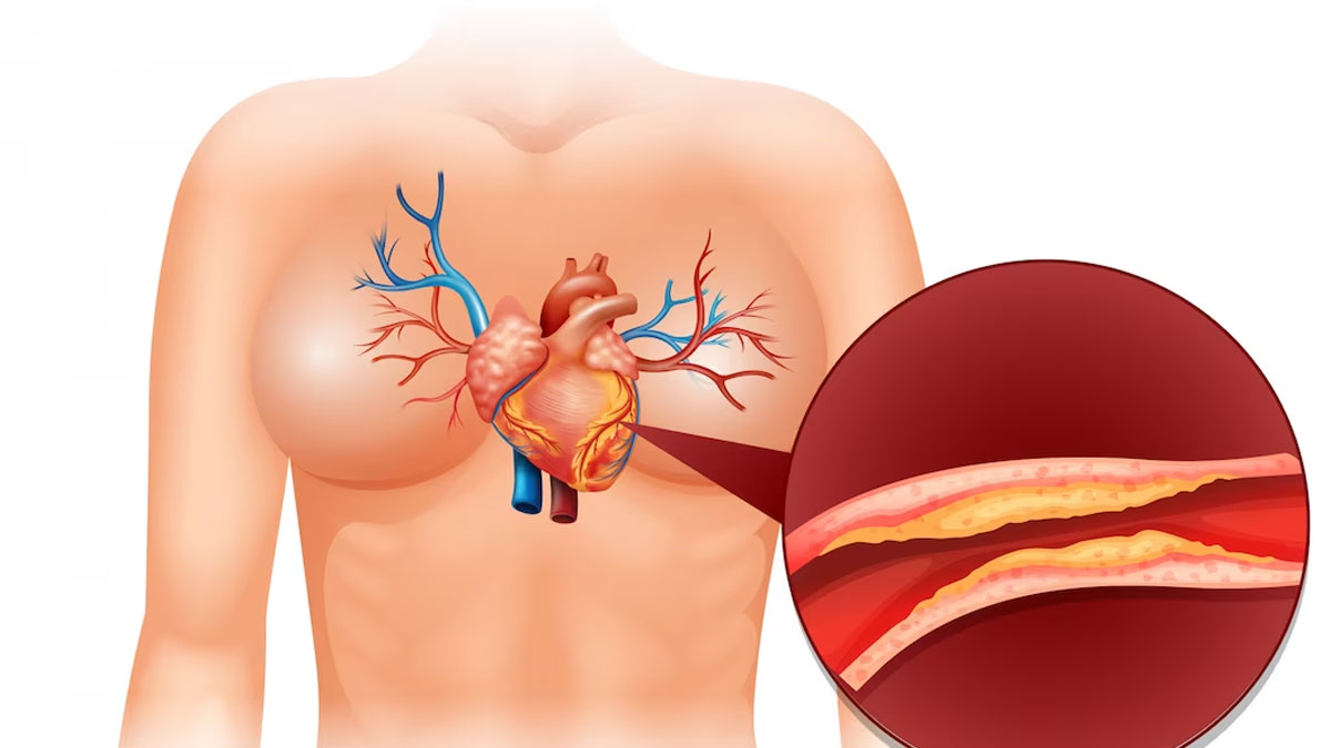 What Is Heart Blockage In Hindi