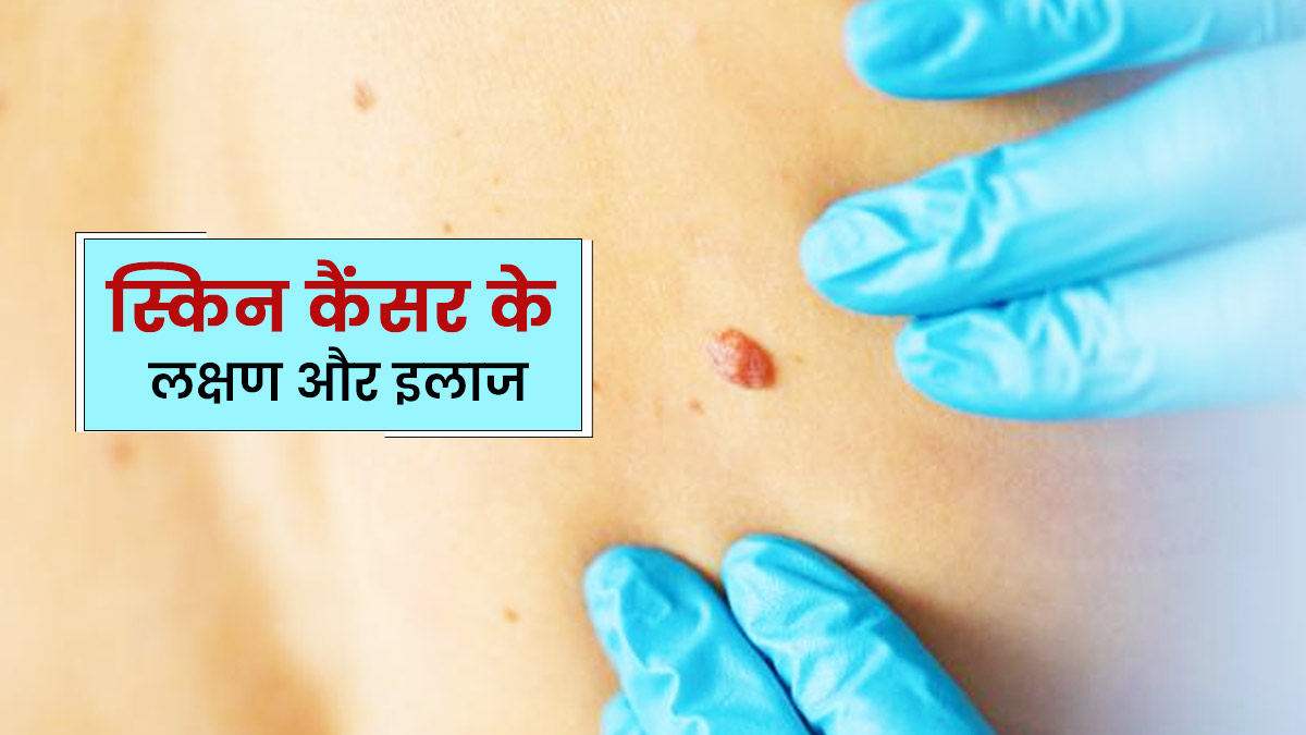 स्किन कैंसर के लक्षण क्या होते हैं? डॉक्टर से जानें इसके बारे में