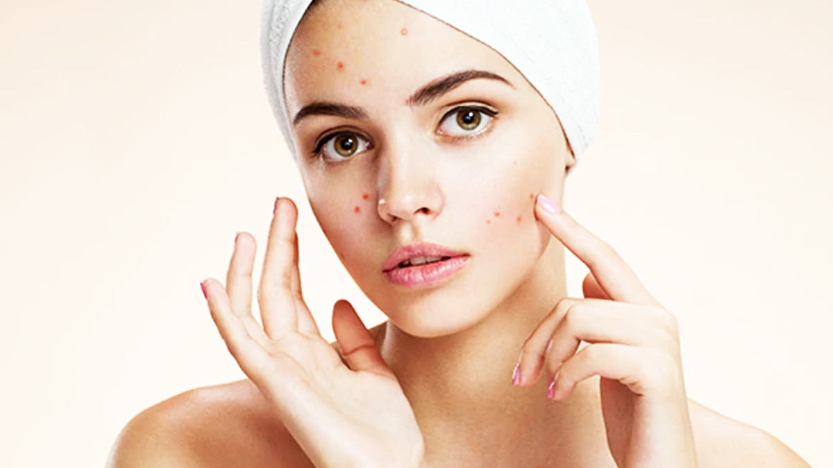 coconut oil for acne