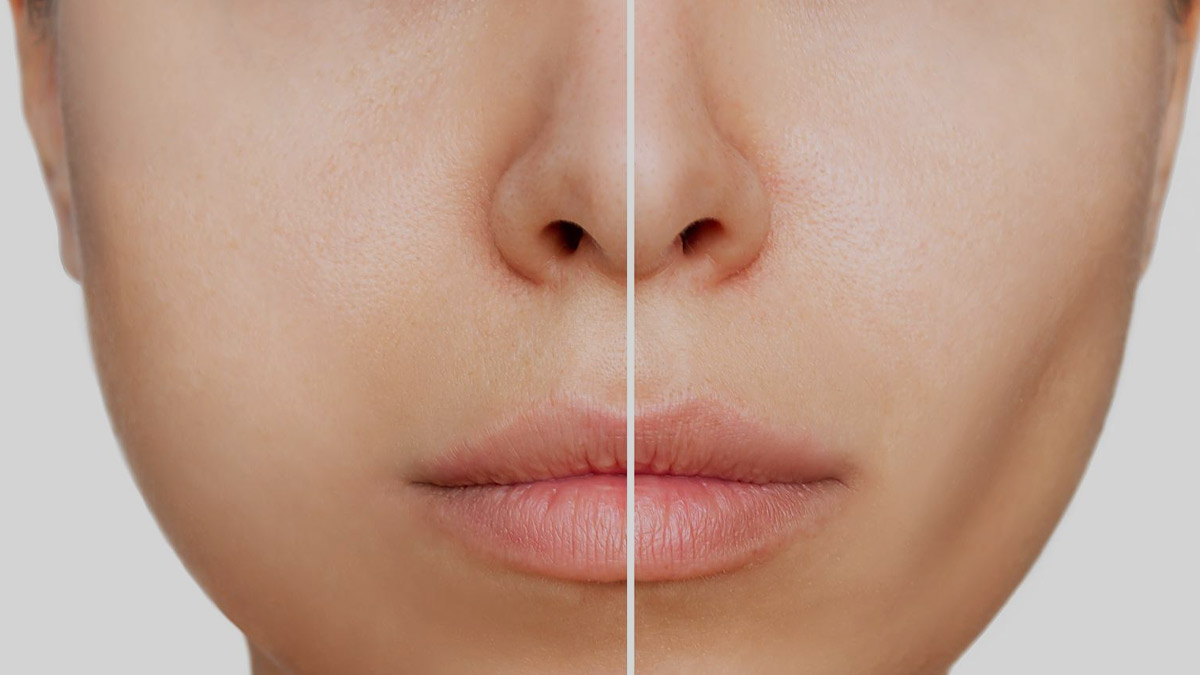 Buccal Fat Removal Surgery: A Costly Procedure That Tones The Cheeks