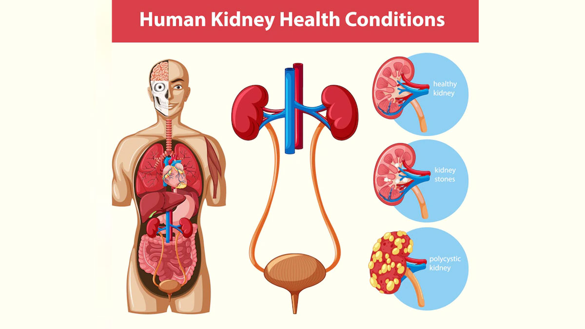 When Is Kidney Replacement Therapy Needed
