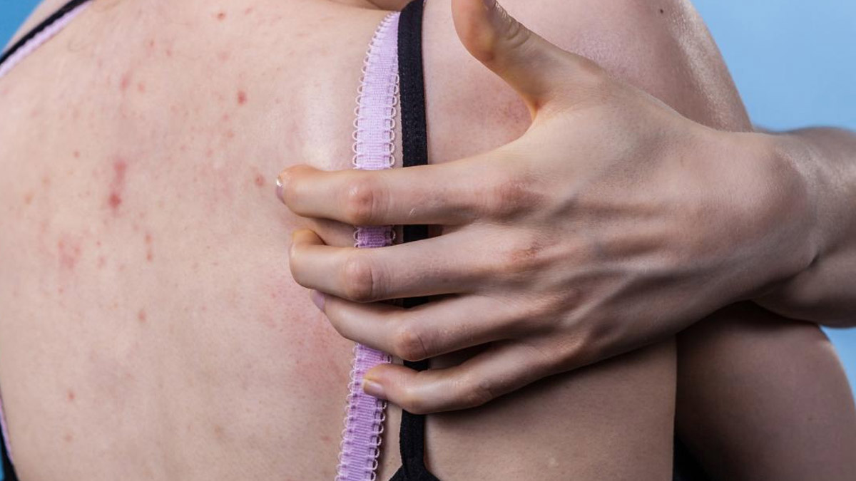 red pimples on back