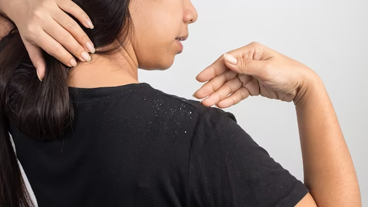 apple cider vinegar and coconut oil to reduce dandruff