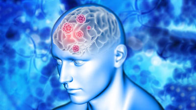 All About Brain Tumours: Treatment, Survival And Quality Of Life Post Treatment