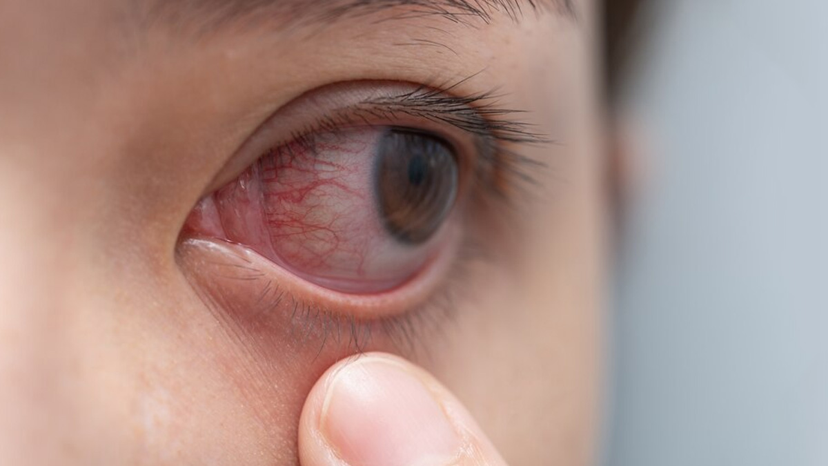 Causes Of Eye Herpes