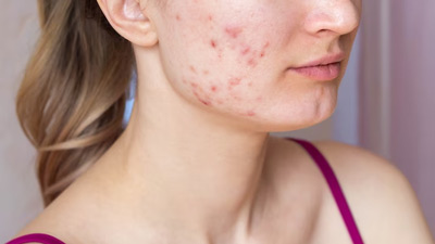 Tired Of Failed Acne Treatment? Expert Lists Reasons Why There Are No Results