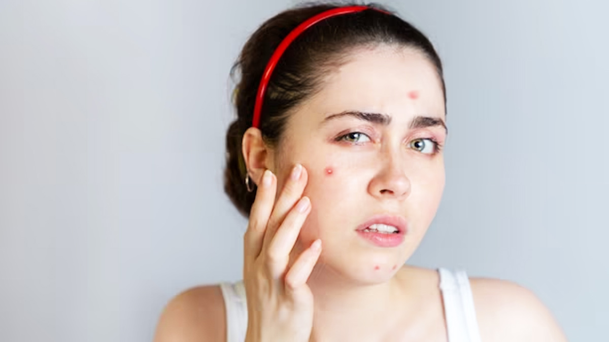 How To Lighten Your Freckles With Ayurvedic Remedies