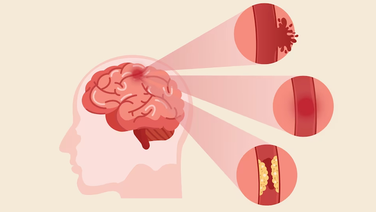 Link-Between-Strenuous-Exercise-And-Stroke-Risk