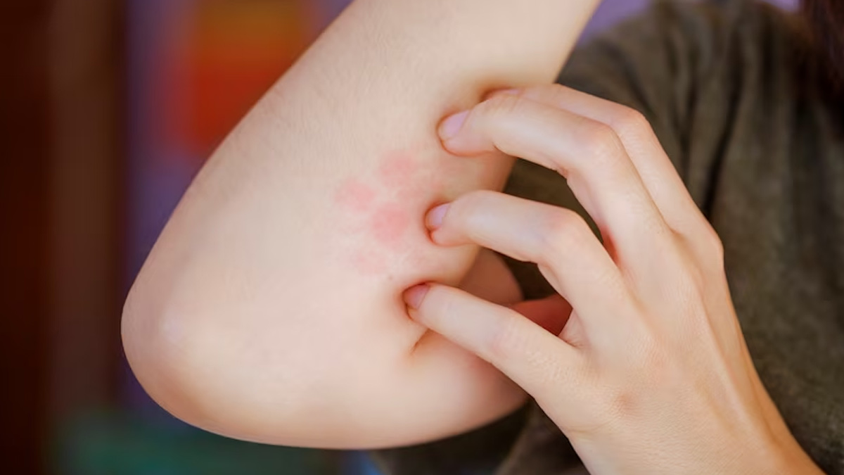 Allergic-Contact-Dermatitis