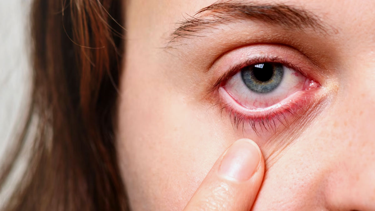 Monsoon Eye Care: Simple Remedies For Conjunctivitis