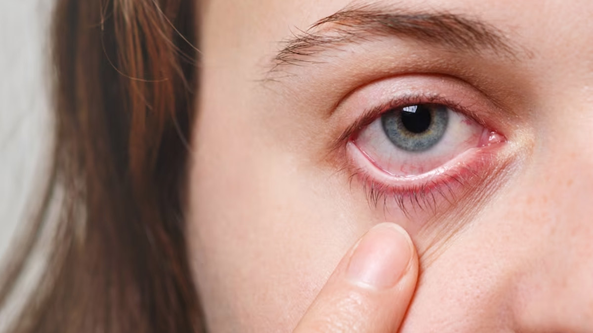 Difference Between Eye Allergy and Eye Infection