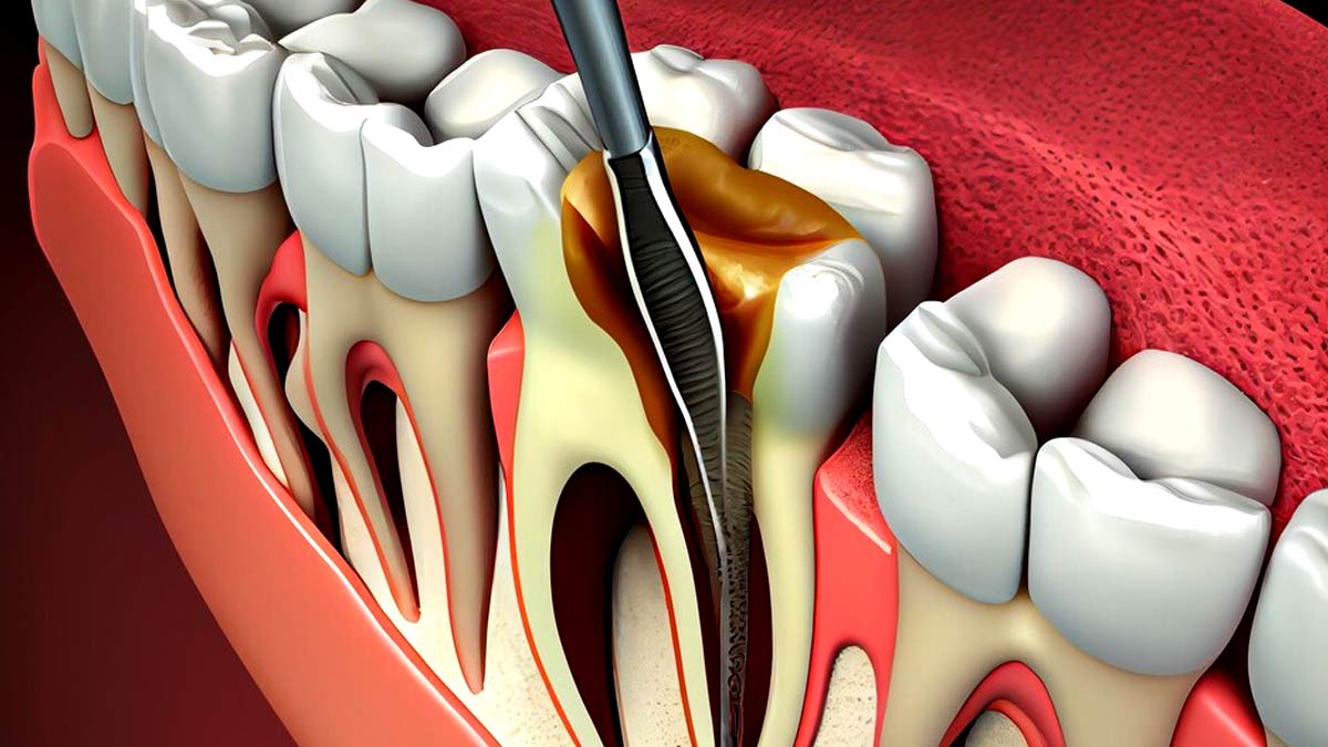 Dental Abscess: Here's What You Need To Know