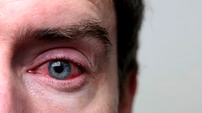 Monsoon Health: Expert Lists Tips To Prevent Conjunctivitis