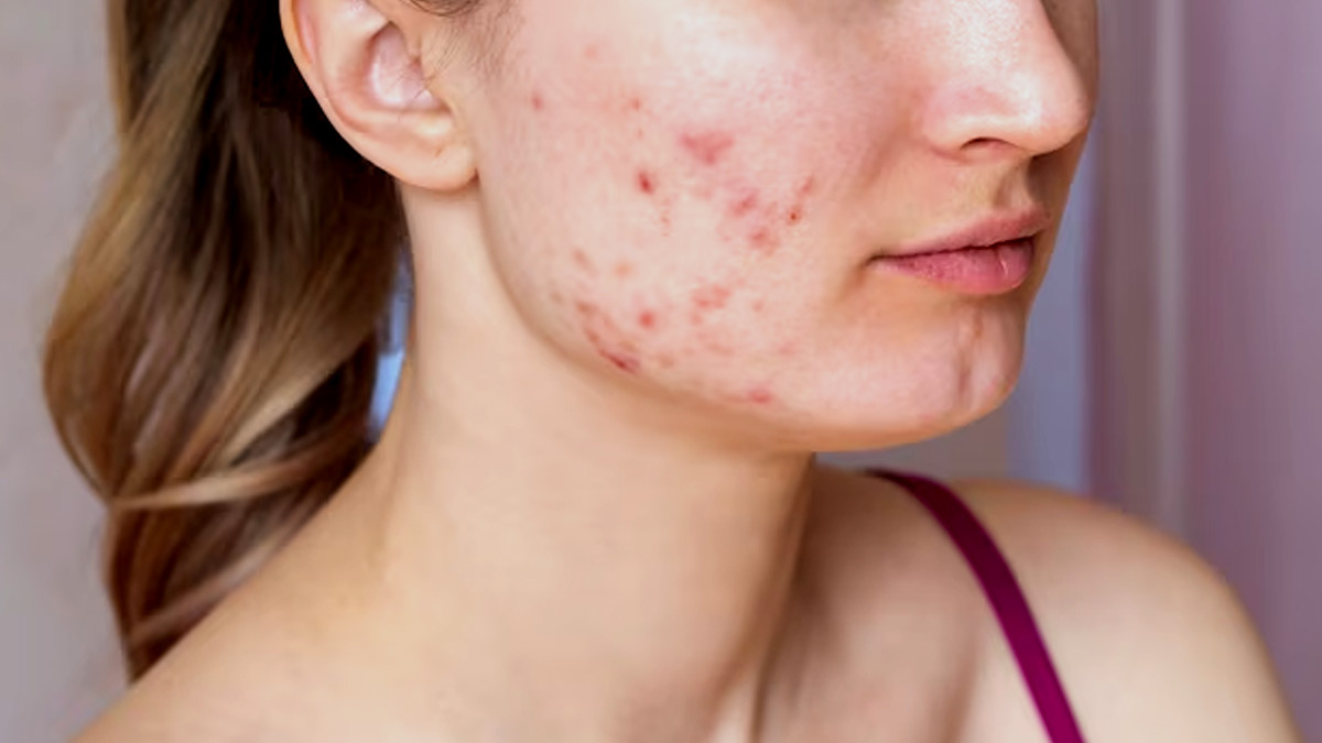 Hormonal Acne: Expert Explains The Connection And Treatment Measures