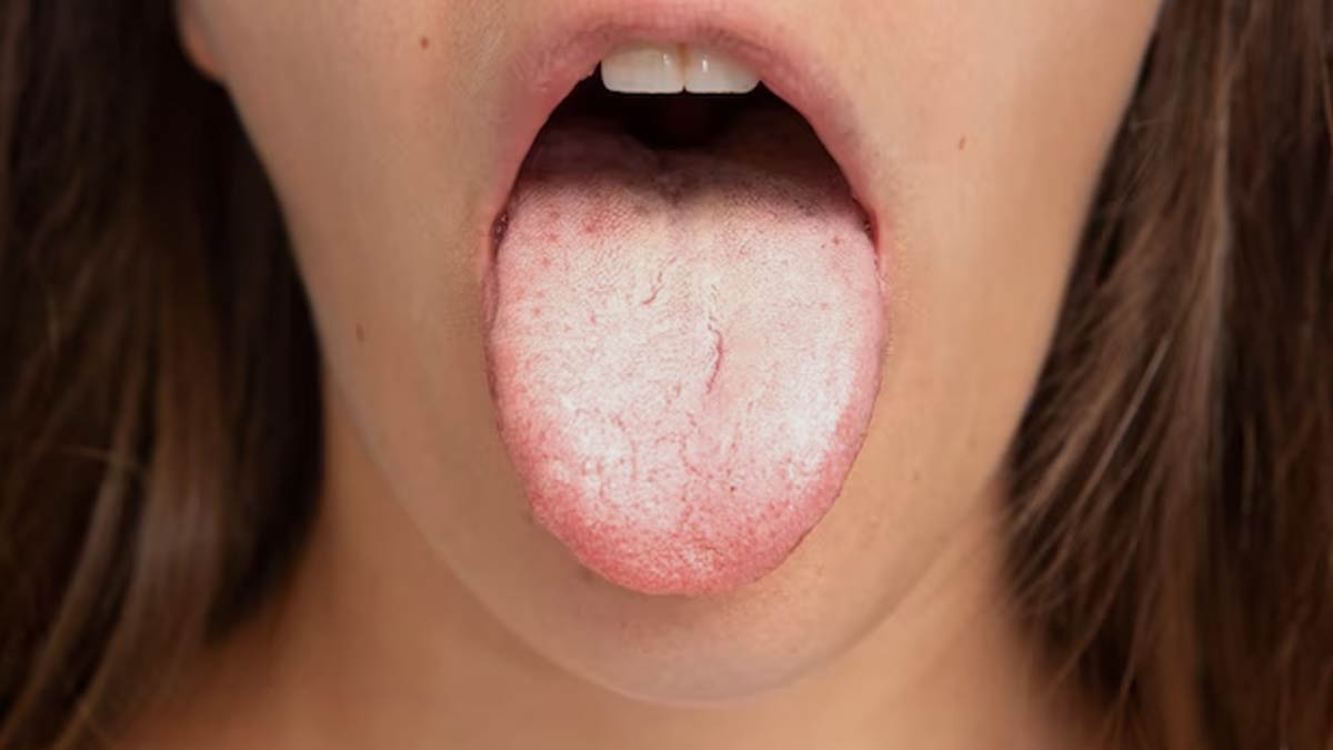 Why Does Your Tongue Suddenly Taste Sour, Expert Explains