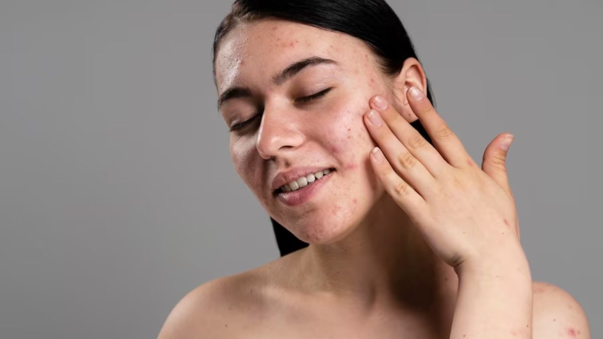 Ginger Benefits To Treat Rosacea