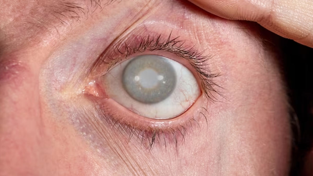 Restoring The Vision: Expert Explains Corneal Transplant And Its Impact