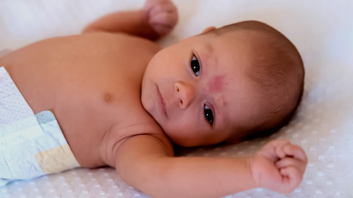 dark circle in infant