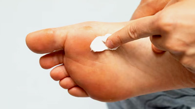My Foot Ulcer Not Healing: Could It Mean Diabetes? 