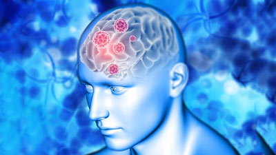  Brain Tumour Headaches: What Are Its Recognising Symptoms and Sensations?