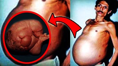 Foetus In Fetu: A Bizarre and Rare Medical Phenomenon Diagnosed In Maharashtra