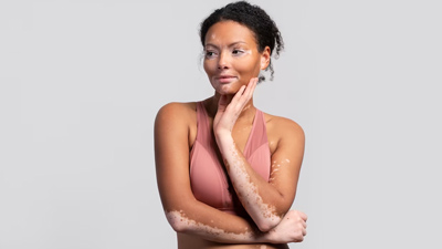 World Vitiligo Day 2023: Dispelling Myths and Misconceptions About Vitiligo
