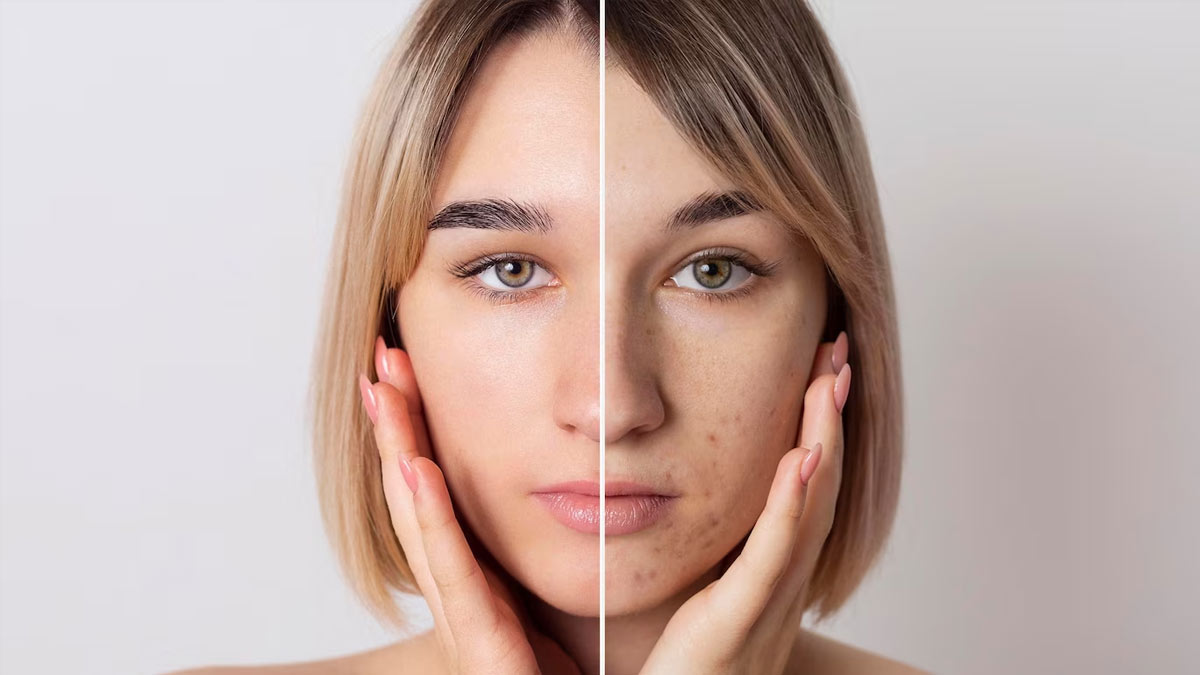 Apple Cider Vinegar To Remove Pigmentation In Hindi