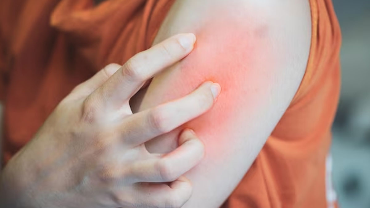 DIY-Prickly-Heat-Powder-to-Get-Quick-Relief-from-Heat-Rash-ins