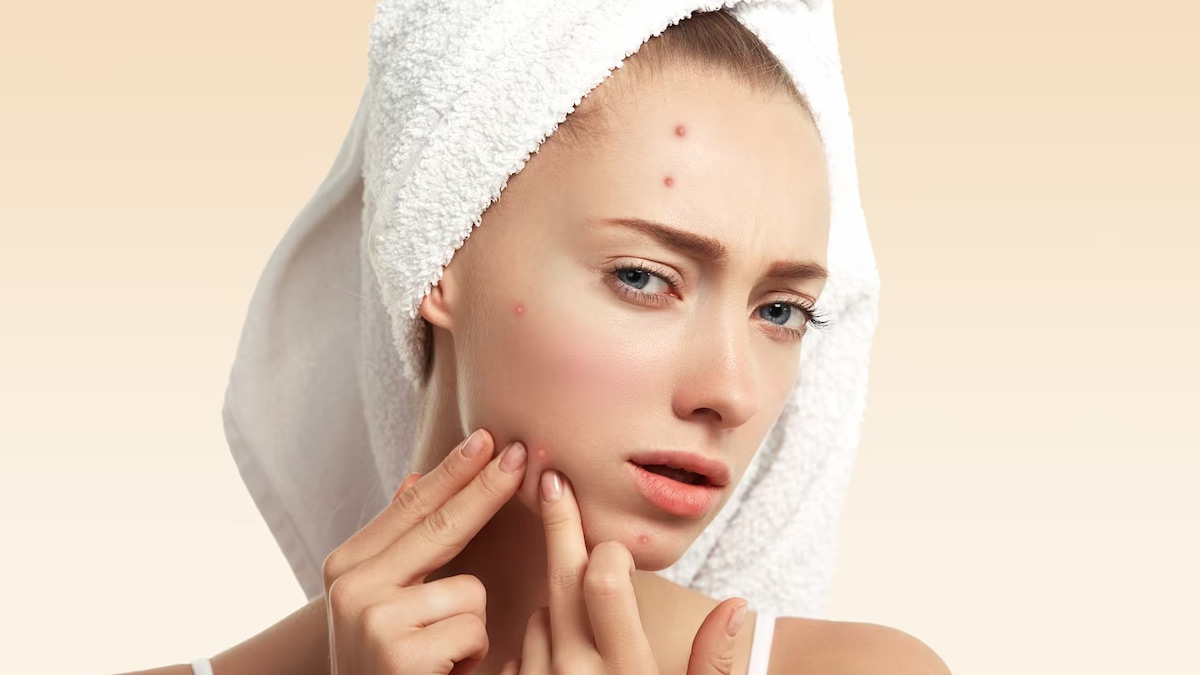 9 Natural Remedies To Get Over Stress Pimples 