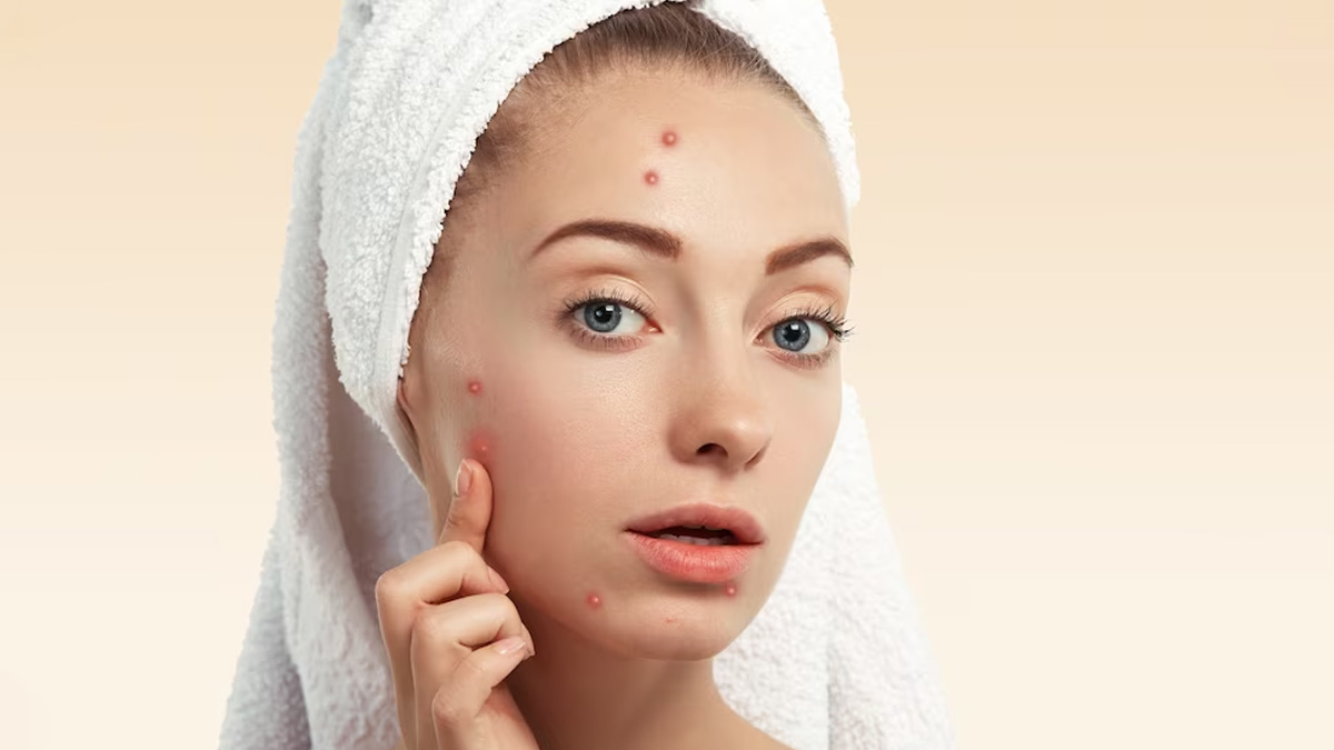 What Is Acne Face Mapping? How Tends To Reveal The True Cause of Pimples