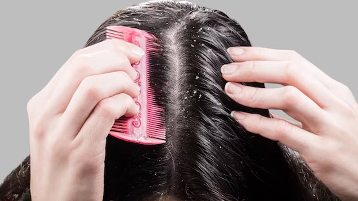 Ginger Juice To Remove Dandruff In Hindi