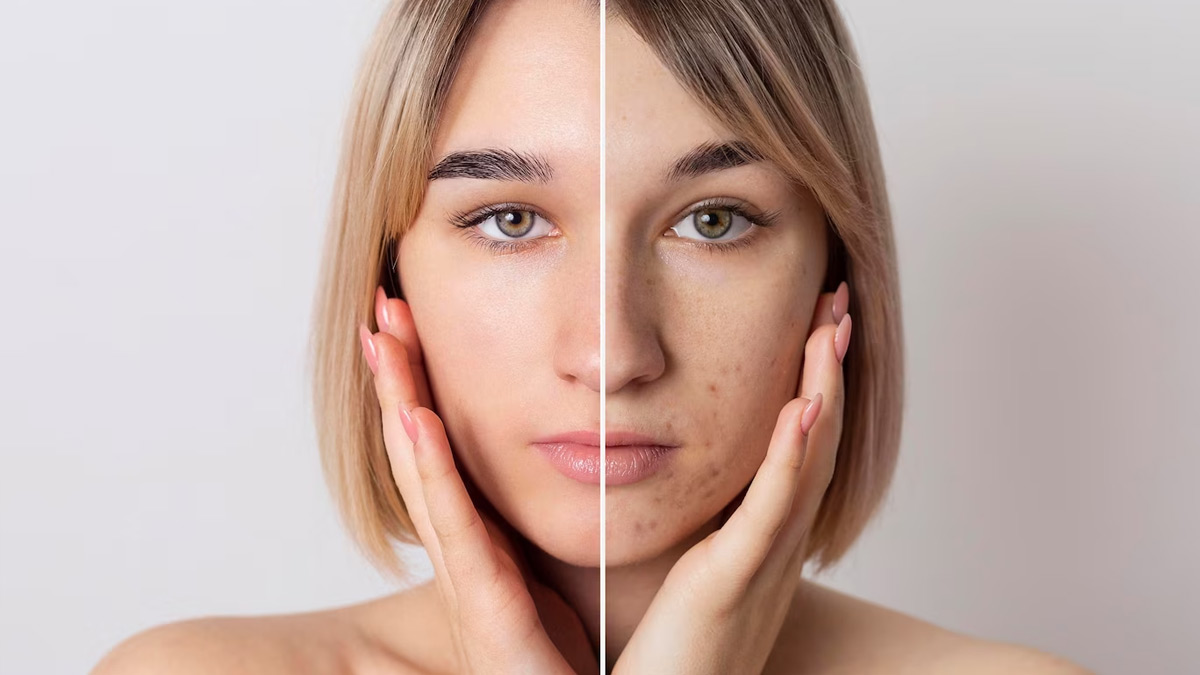 Onion And Garlic Face Pack For Dark Spots In HIndi