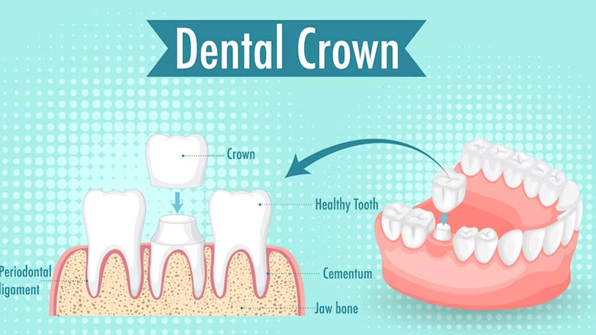 What Are Dental Crowns Bridges Expert Weighs In Onlymyhealth