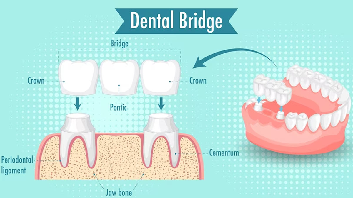 What Are Dental Crowns Bridges Expert Weighs In OnlyMyHealth