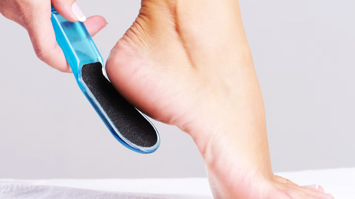 cracked heel treatment