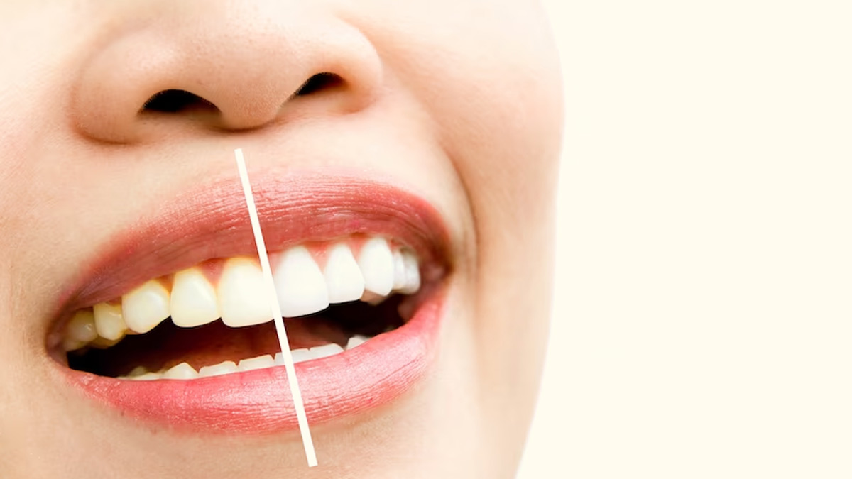 Benefits Of Lemon Juice For Oral Health