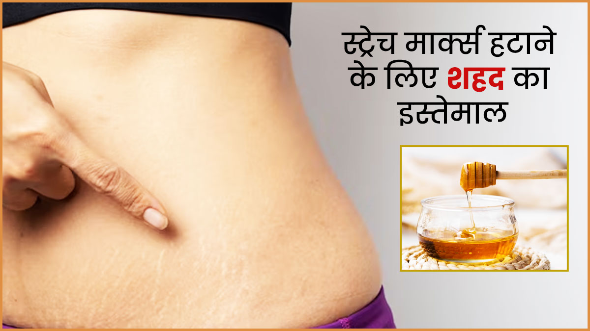 जिद्दी स्ट्रेच मार्क्स को हटाने में फायदेमंद है शहद, इन 4 तरीकों से करें इस्तेमाल