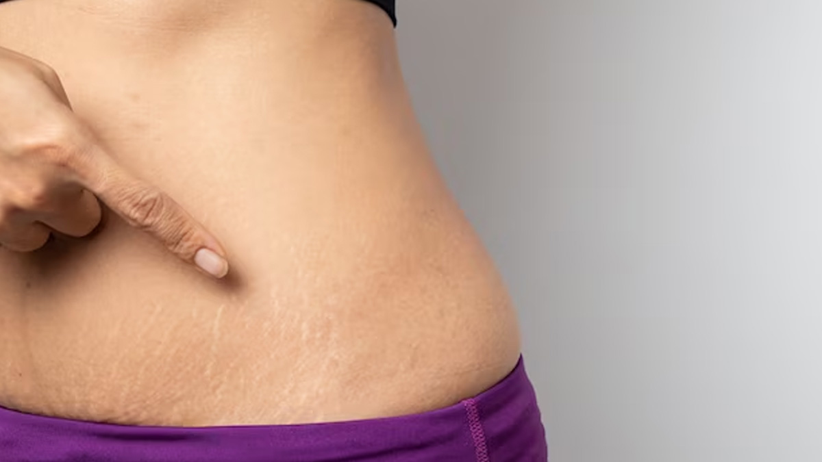 lavender oil for stretch marks in hindi