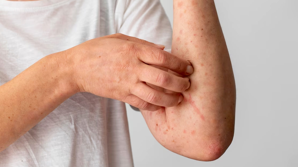 fungal infection treatment