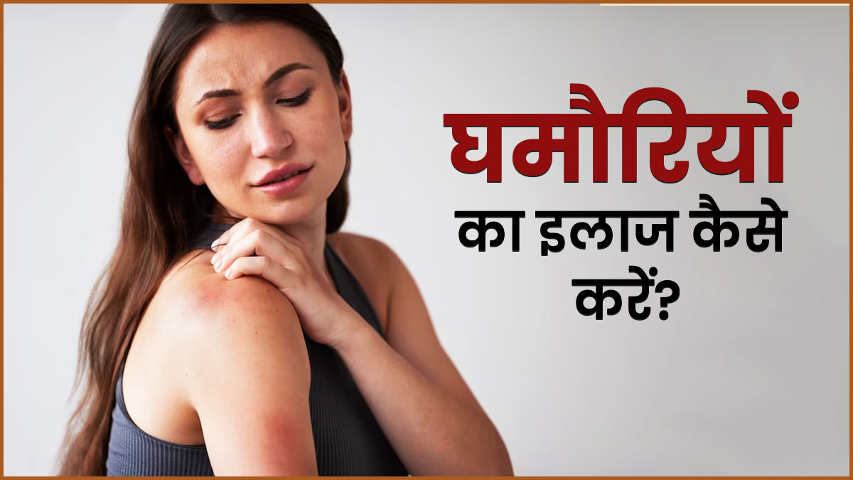गर्मी में घमौरियां दूर करने के लिए इस्तेमाल करें दही, जल्द मिलेगा आराम