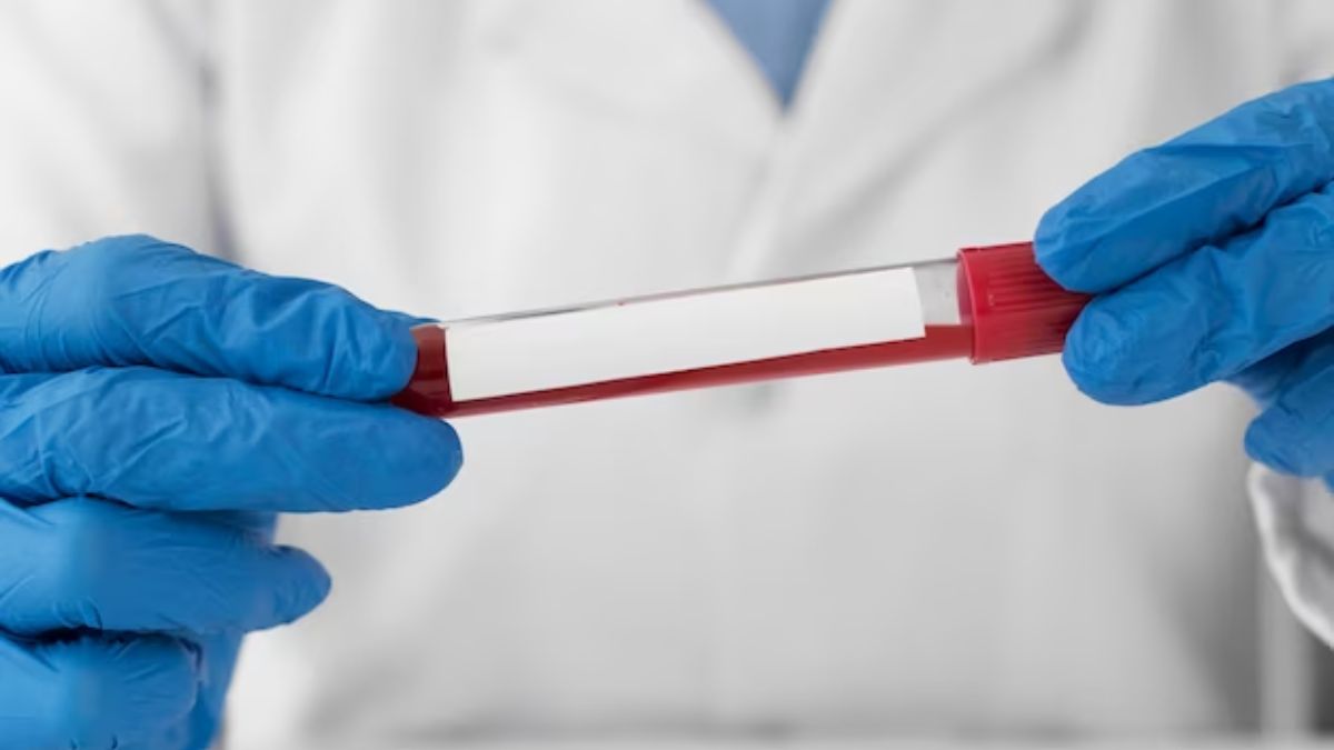 Normal Platelet Count in Children