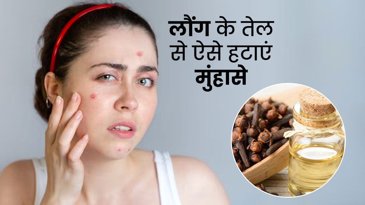 मुंहासे हटाने के लिए इस तरह करें लौंग के तेल का प्रयोग, चेहरे का कालापन भी होगा दूर