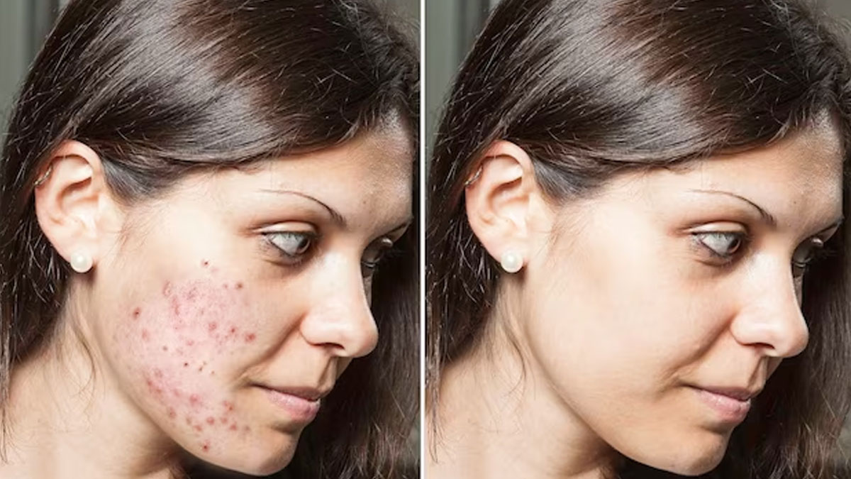 Clove Oil To Remove Acne Pimples In Hindi