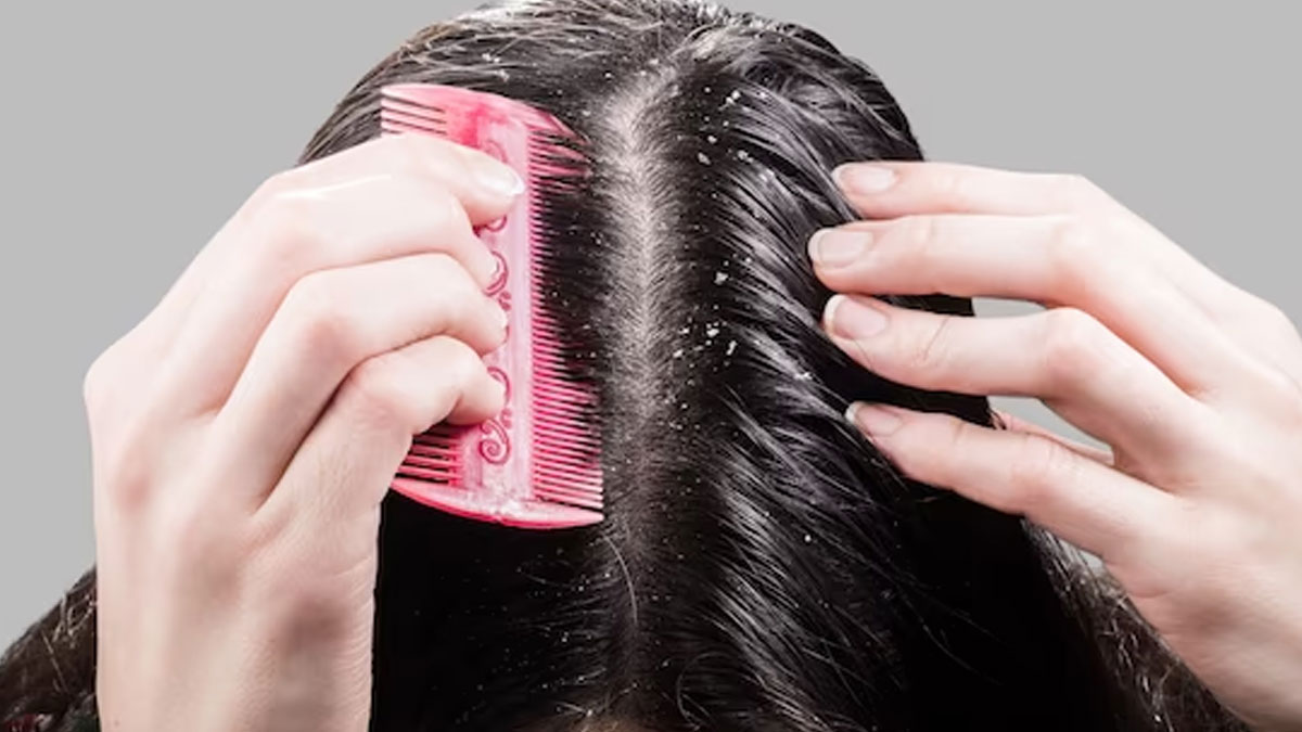 Coconut Milk For Dandruff In Hindi