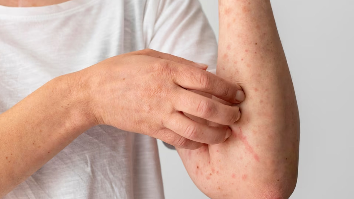 Chicken pox Kyu Hota Hai