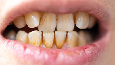 Healthy Teeth, Healthy Smile: Home Remedies To Get Rid Of Tartar From Teeth 