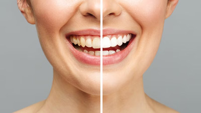 Salt And Sarson (Mustard Oil): Does The Combination Really Help Whiten Teeth?