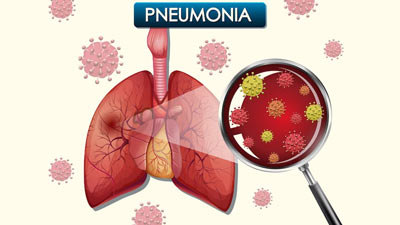 Pneumonia Among Diabetic Patients: What Are The Risk Factors One Should Know 