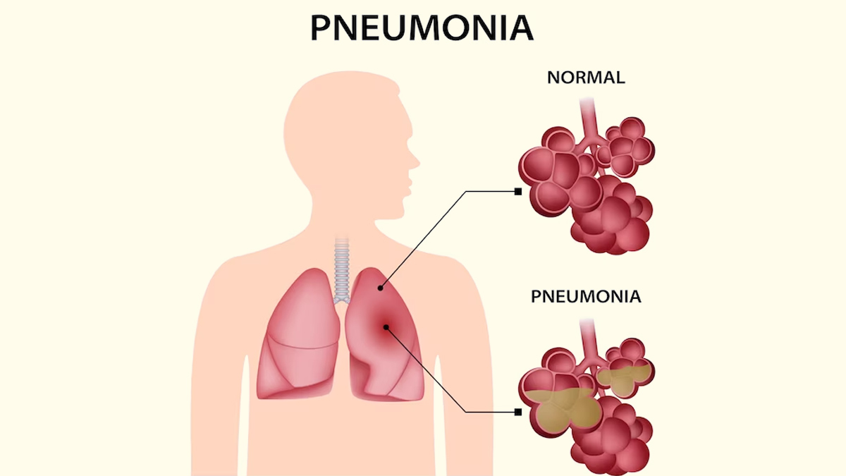 Mysterious Pneumonia Outbreak Raises Concerns in China WHO Report